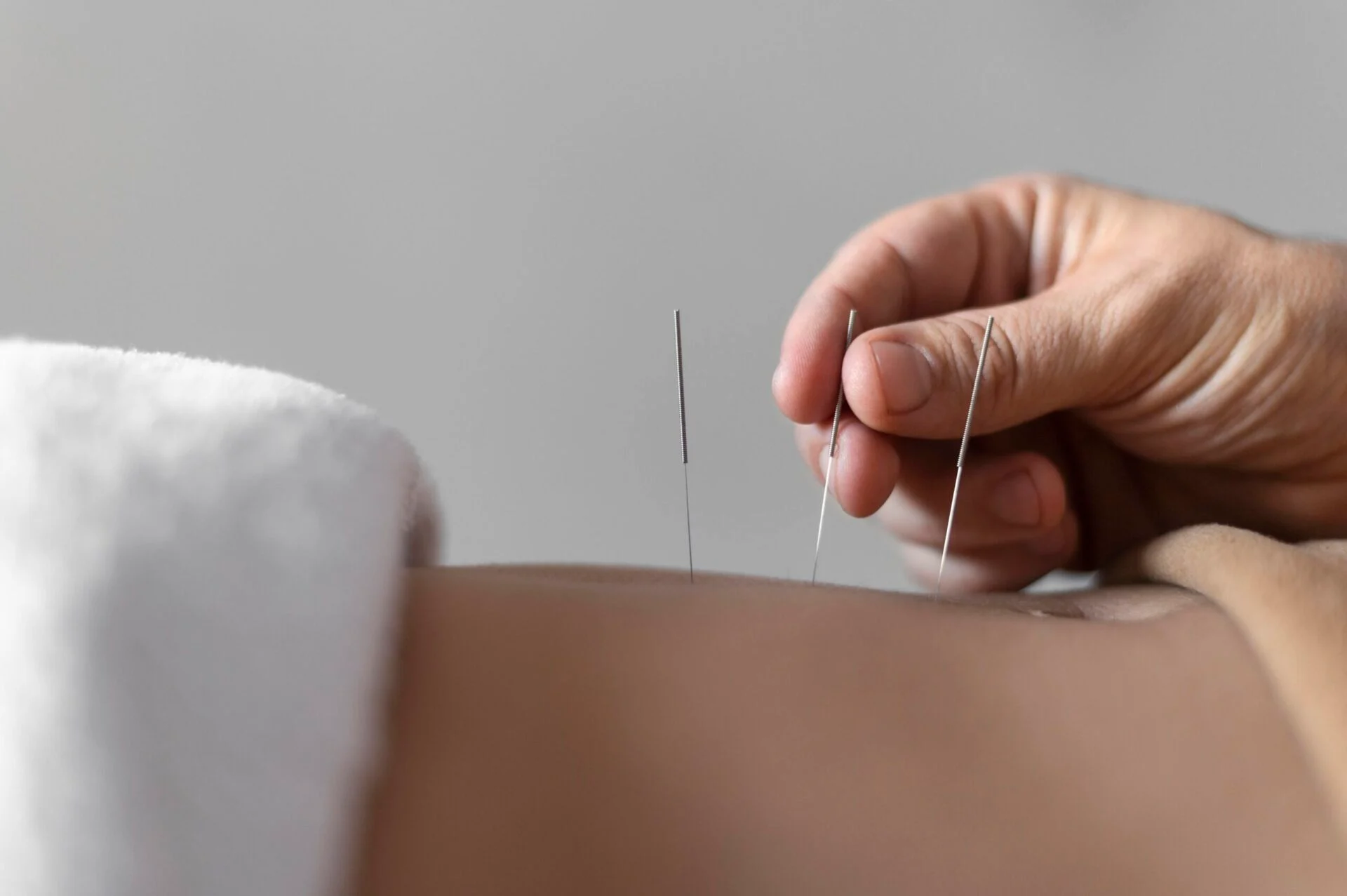 How Does Acupuncture Help In Weight Loss?